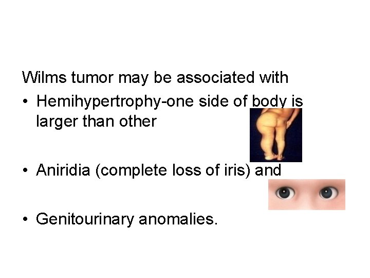 Wilms tumor may be associated with • Hemihypertrophy-one side of body is larger than