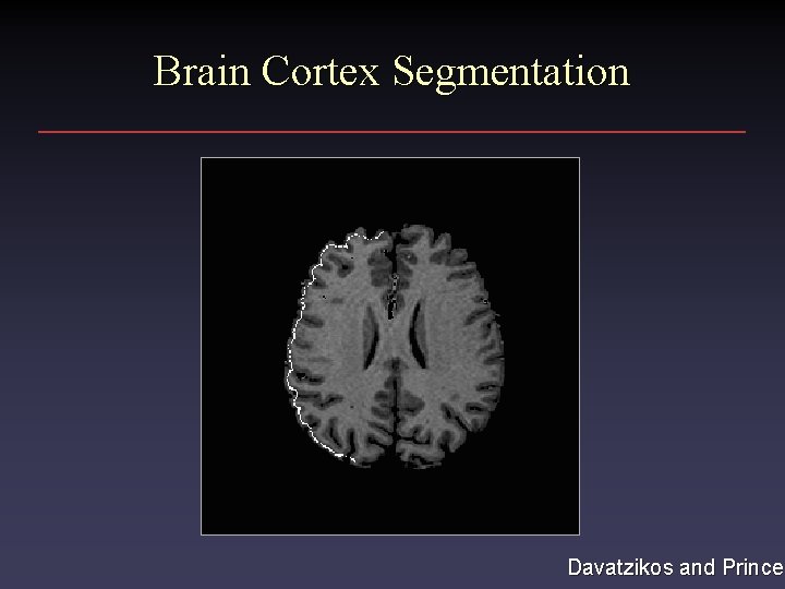 Brain Cortex Segmentation Davatzikos and Prince Brain Cortex Segmentation Davatzikos and Prince
