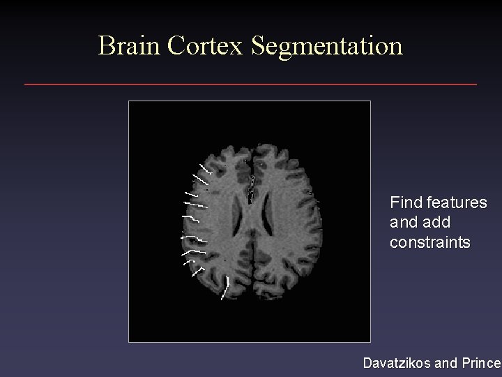 Brain Cortex Segmentation Find features and add constraints Davatzikos and Prince 