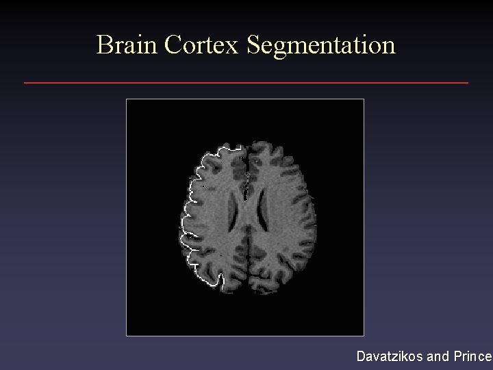 Brain Cortex Segmentation Davatzikos and Prince 