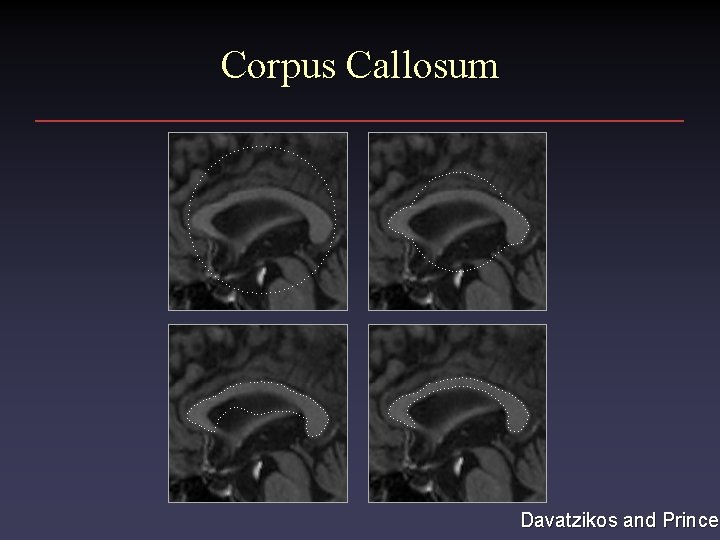 Corpus Callosum Davatzikos and Prince Corpus Callosum Davatzikos and Prince