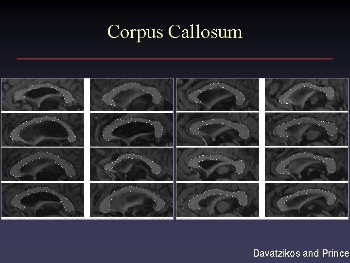 Corpus Callosum Davatzikos and Prince Corpus Callosum Davatzikos and Prince