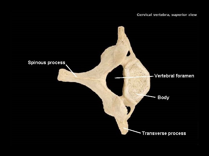 Spinous process Vertebral foramen Body Transverse process 