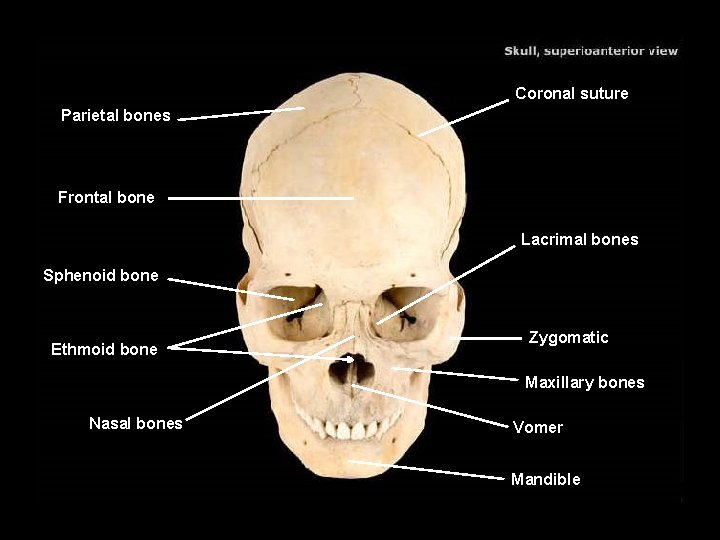 Coronal suture Parietal bones Frontal bone Lacrimal bones Sphenoid bone Ethmoid bone Zygomatic Maxillary