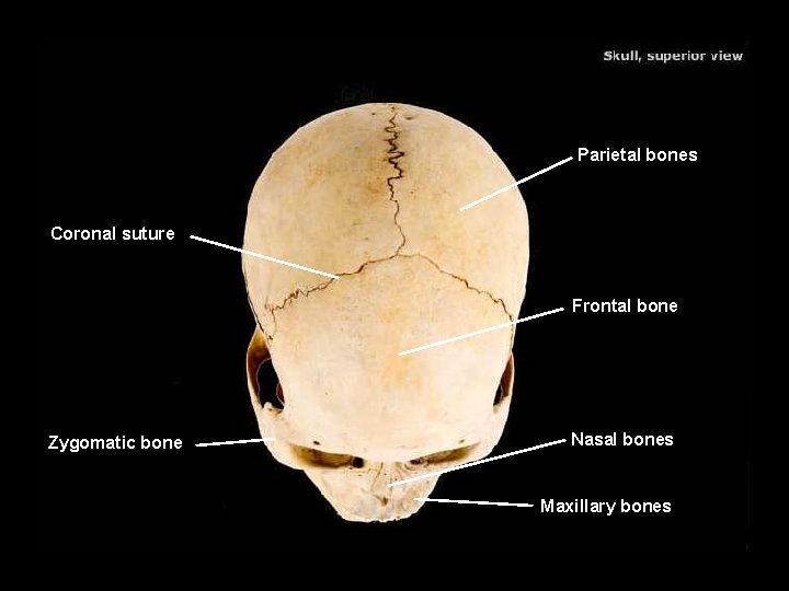 Parietal bones Coronal suture Frontal bone Zygomatic bone Nasal bones Maxillary bones 