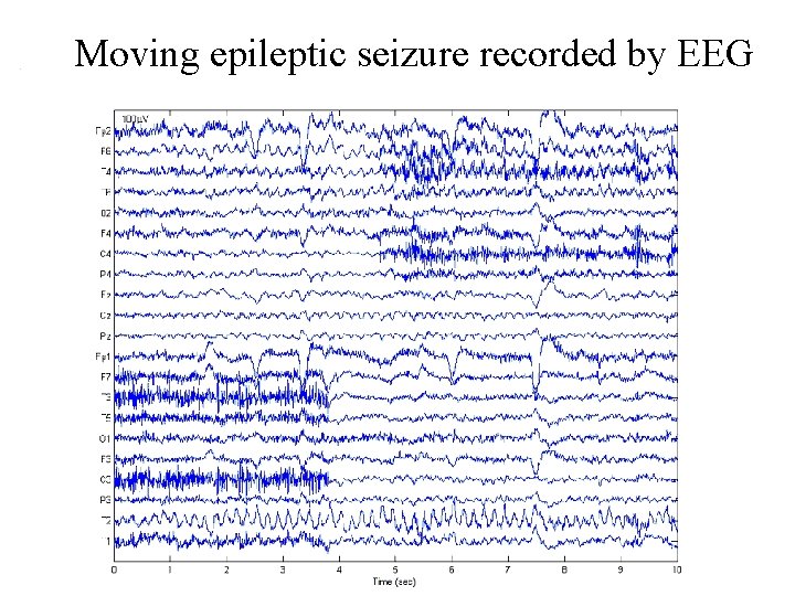 Moving epileptic seizure recorded by EEG 
