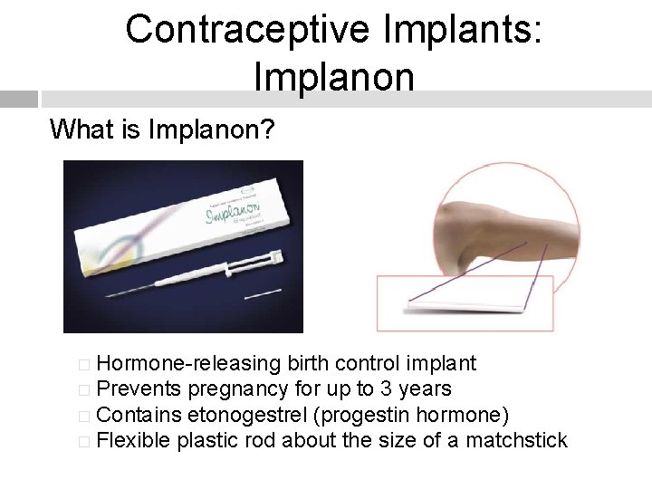 Contraceptive Implants: Implanon What is Implanon? � Hormone-releasing birth control implant � Prevents pregnancy