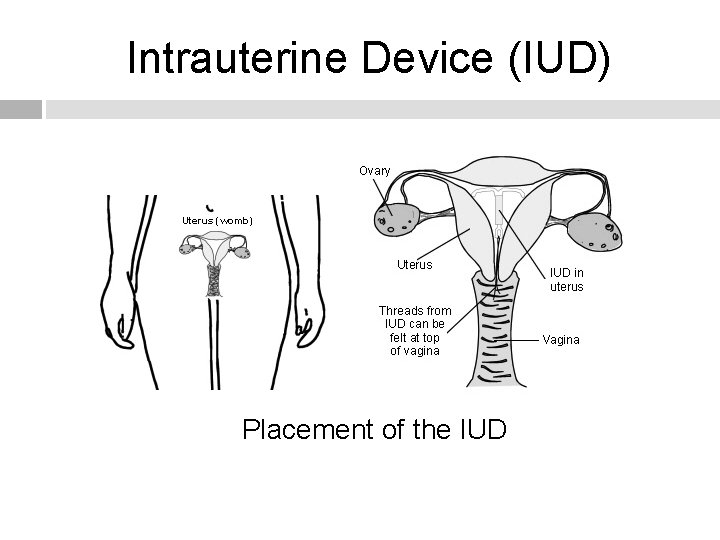 Intrauterine Device (IUD) Placement of the IUD 