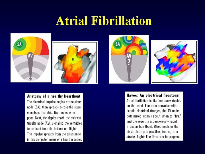 Atrial Fibrillation 