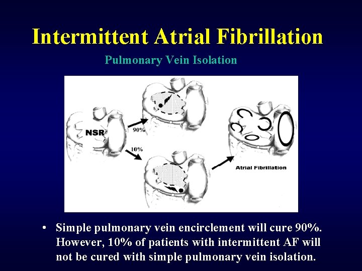 Intermittent Atrial Fibrillation Pulmonary Vein Isolation • Simple pulmonary vein encirclement will cure 90%.