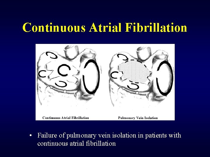 Continuous Atrial Fibrillation • Failure of pulmonary vein isolation in patients with continuous atrial