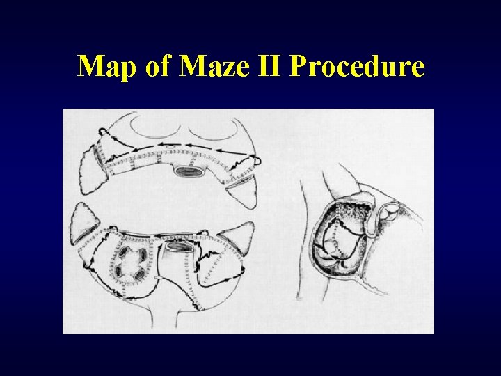 Map of Maze II Procedure 