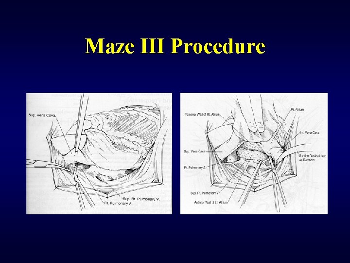 Maze III Procedure 