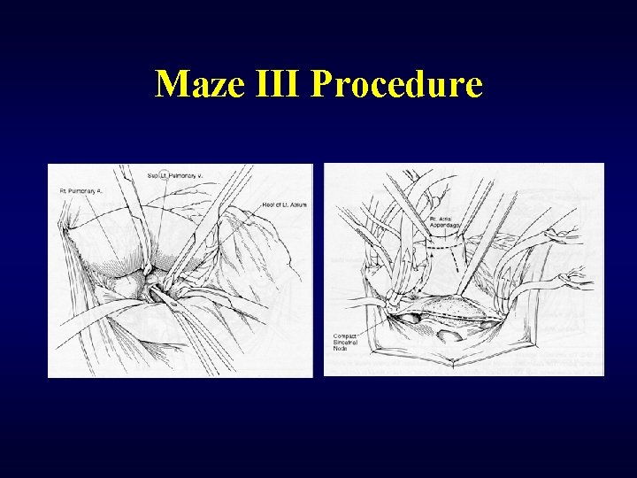 Maze III Procedure 