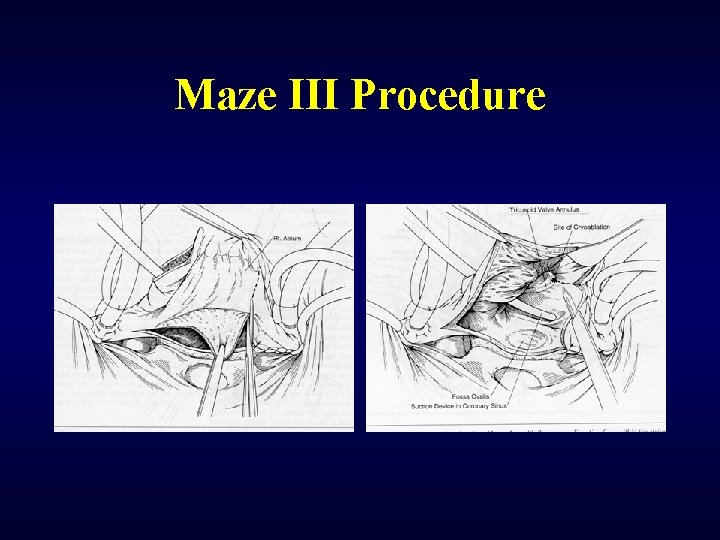 Maze III Procedure 