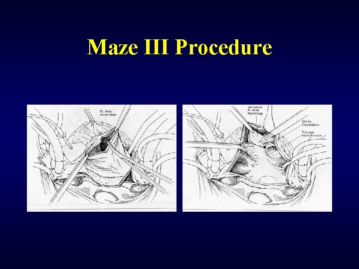 Maze III Procedure 