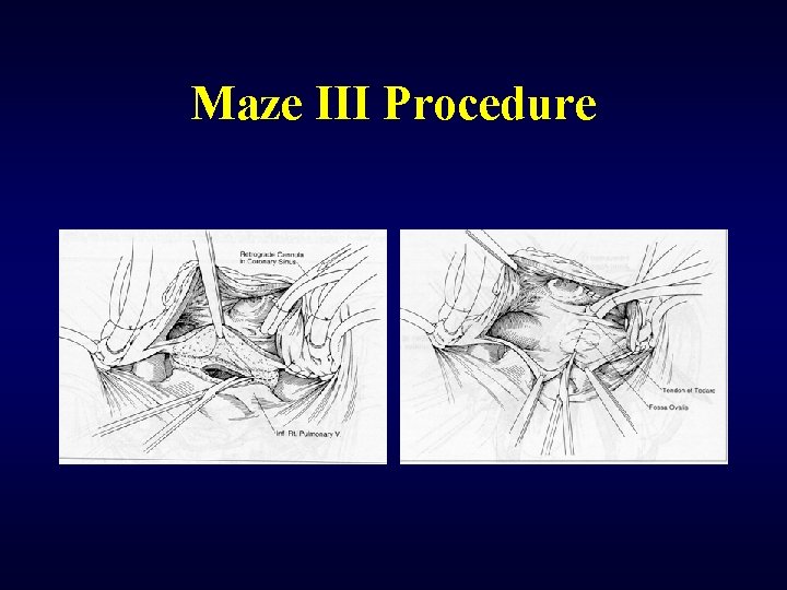 Maze III Procedure 