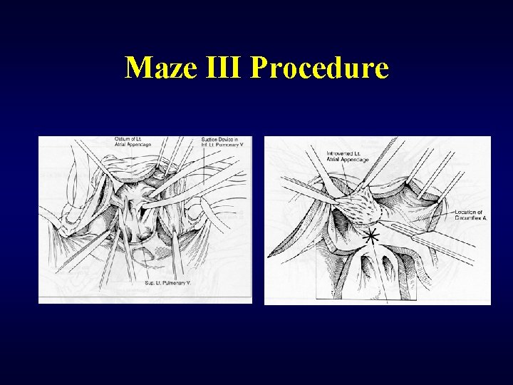 Maze III Procedure 