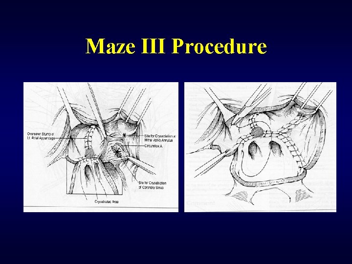 Maze III Procedure 