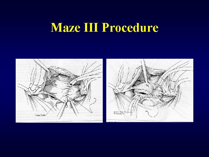 Maze III Procedure 