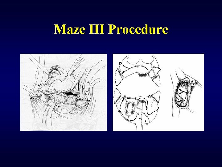 Maze III Procedure 