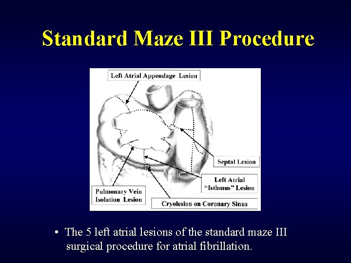 Standard Maze III Procedure • The 5 left atrial lesions of the standard maze