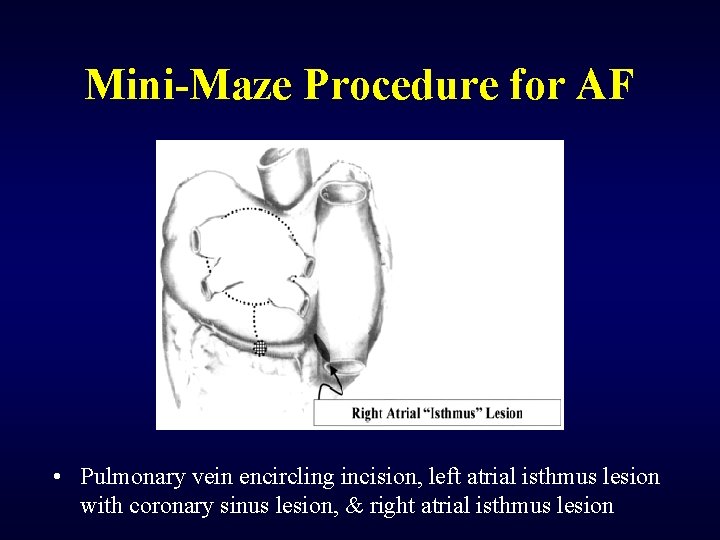Mini-Maze Procedure for AF • Pulmonary vein encircling incision, left atrial isthmus lesion with
