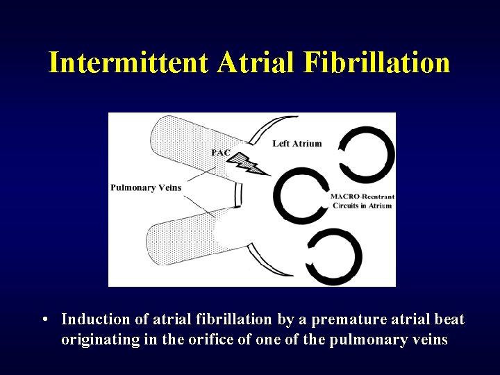 Intermittent Atrial Fibrillation • Induction of atrial fibrillation by a premature atrial beat originating