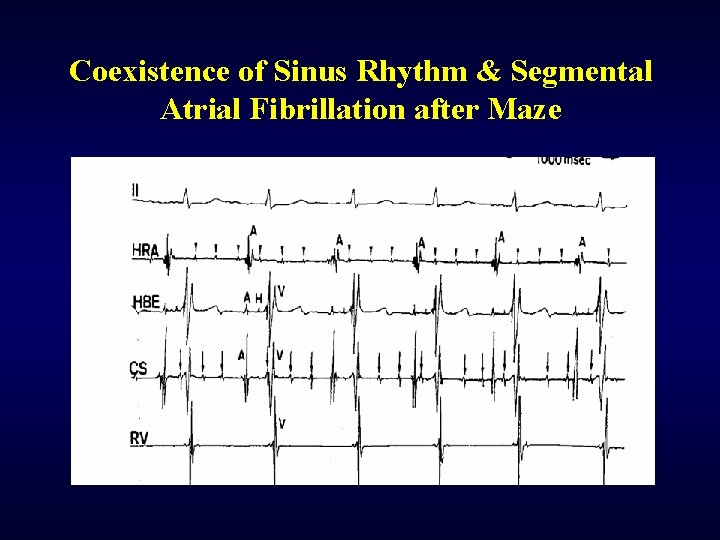 Coexistence of Sinus Rhythm & Segmental Atrial Fibrillation after Maze 