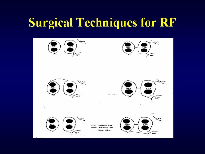 Surgical Techniques for RF 