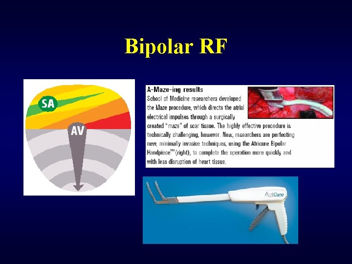 Bipolar RF 