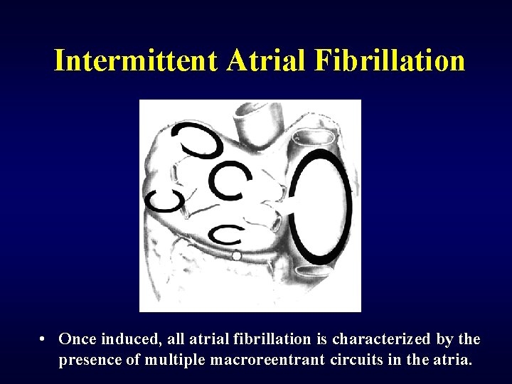 Intermittent Atrial Fibrillation • Once induced, all atrial fibrillation is characterized by the presence