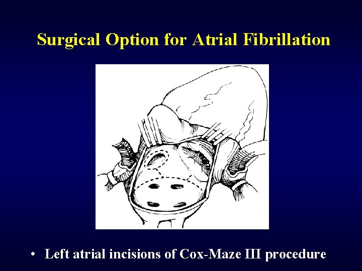 Surgical Option for Atrial Fibrillation • Left atrial incisions of Cox-Maze III procedure 