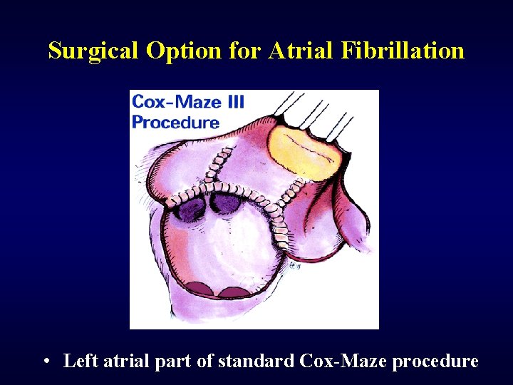 Surgical Option for Atrial Fibrillation • Left atrial part of standard Cox-Maze procedure 