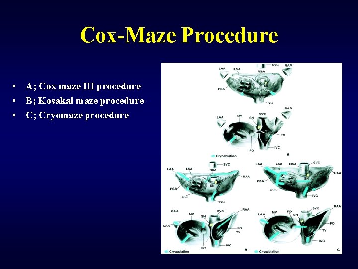 Cox-Maze Procedure • A; Cox maze III procedure • B; Kosakai maze procedure •
