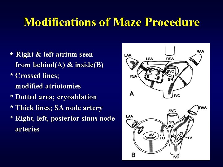 Modifications of Maze Procedure * Right & left atrium seen from behind(A) & inside(B)