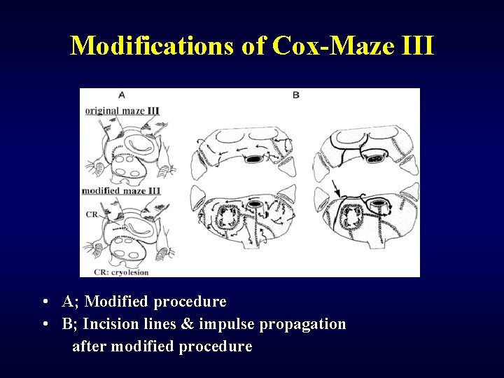 Modifications of Cox-Maze III • A; Modified procedure • B; Incision lines & impulse