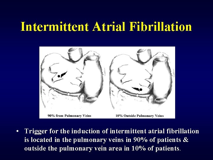 Intermittent Atrial Fibrillation • Trigger for the induction of intermittent atrial fibrillation is located