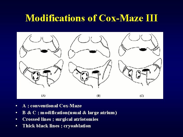 Modifications of Cox-Maze III • • A ; conventional Cox-Maze B & C ;