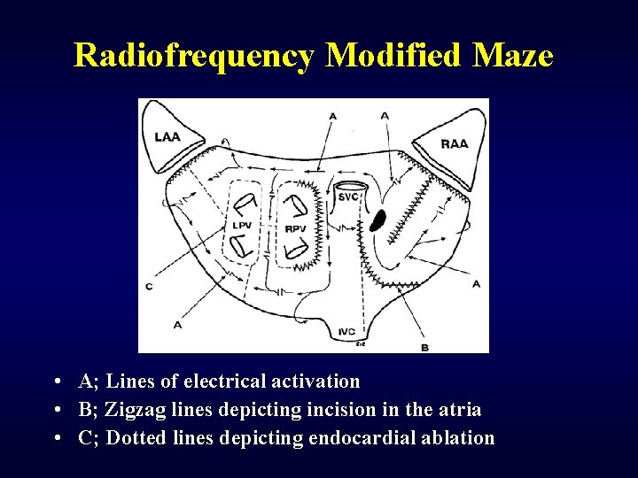 Radiofrequency Modified Maze • A; Lines of electrical activation • B; Zigzag lines depicting