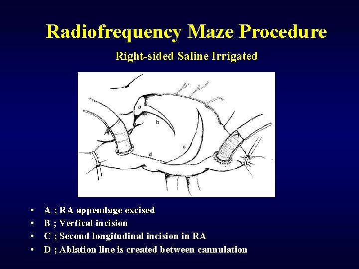 Radiofrequency Maze Procedure Right-sided Saline Irrigated • • A ; RA appendage excised B