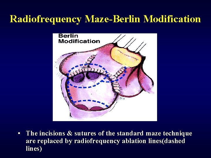 Radiofrequency Maze-Berlin Modification • The incisions & sutures of the standard maze technique are