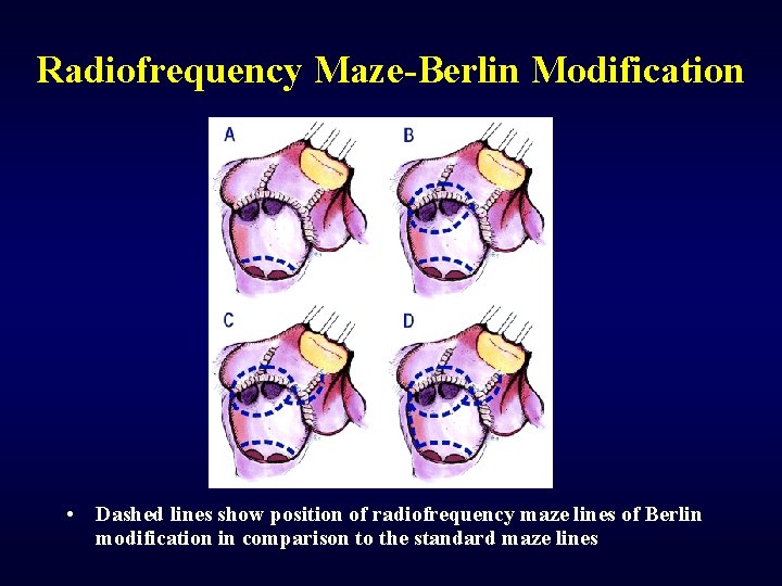 Radiofrequency Maze-Berlin Modification • Dashed lines show position of radiofrequency maze lines of Berlin