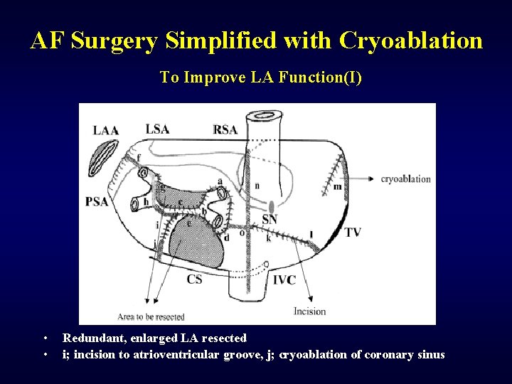 AF Surgery Simplified with Cryoablation To Improve LA Function(I) • • Redundant, enlarged LA