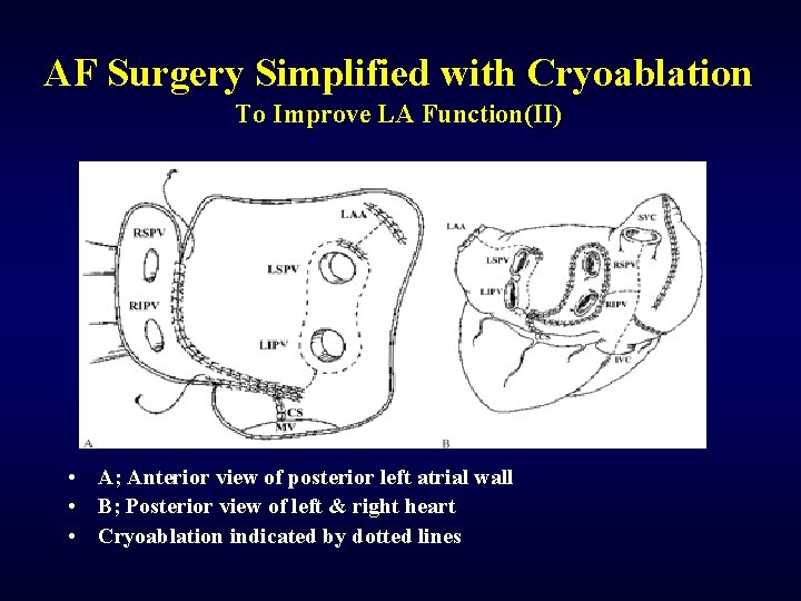 AF Surgery Simplified with Cryoablation To Improve LA Function(II) • A; Anterior view of