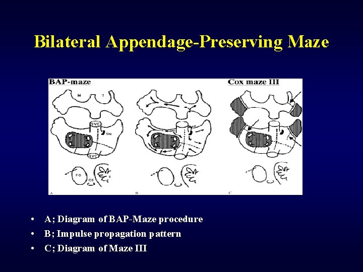 Bilateral Appendage-Preserving Maze • A; Diagram of BAP-Maze procedure • B; Impulse propagation pattern