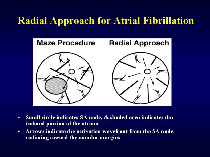 Radial Approach for Atrial Fibrillation • Small circle indicates SA node, & shaded area