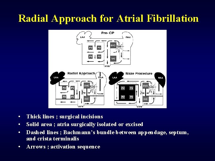 Radial Approach for Atrial Fibrillation • Thick lines ; surgical incisions • Solid area