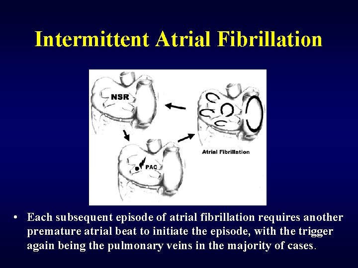 Intermittent Atrial Fibrillation • Each subsequent episode of atrial fibrillation requires another premature atrial
