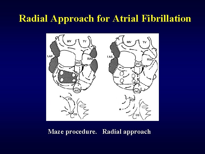 Radial Approach for Atrial Fibrillation Maze procedure. Radial approach 